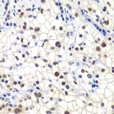 Immunohistochemistry: RAP30 Antibody [NBP3-17982] - Paraffin-embedded human kidney cancer using RAP74 .