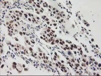 Immunohistochemistry: RAP30 Antibody (OTI4B10) - Azide and BSA Free [NBP2-73801] - Staining of paraffin-embedded Carcinoma of Human lung tissue using anti-RAP30 mouse monoclonal antibody.