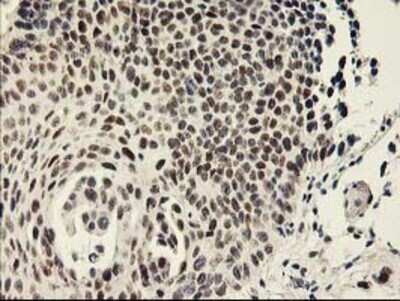 Immunohistochemistry: RAP74 Antibody (OTI4B10) - Azide and BSA Free [NBP3-17972] - Staining of paraffin-embedded Carcinoma of Human bladder tissue using anti-RAP74 mouse monoclonal antibody.