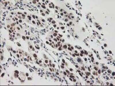 Immunohistochemistry: RAP74 Antibody (OTI4B10) - Azide and BSA Free [NBP3-17972] - Staining of paraffin-embedded Carcinoma of Human lung tissue using anti-RAP74 mouse monoclonal antibody.