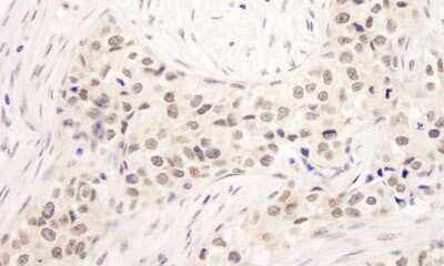 <b>Independent Antibodies Validation and Biological Strategies Validation.</b>Immunohistochemistry: RAP80 Antibody [NB100-2347] - Sample: FFPE section of human breast carcinoma. Antibody: Affinity purified rabbit anti- RAP80 used at a dilution of 1:1,000 (1ug/ml). Detection: DAB