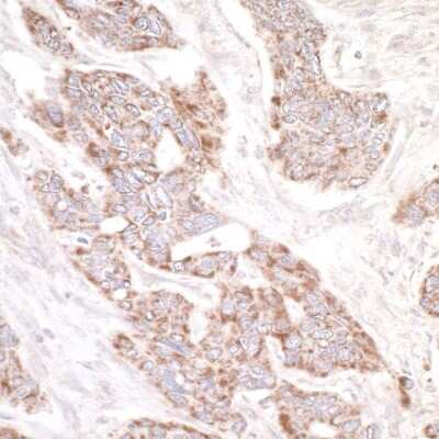 Immunohistochemistry-Paraffin: RAPGEF2 Antibody [NBP1-06549] - Human ovarian carcinoma. Antibody: Affinity purified rabbit anti- PDZ-GEF1 used at a dilution of 1:5,000 (0.2ug/ml). Detection: DAB