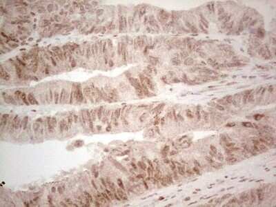 Immunohistochemistry: RAR alpha/NR1B1 Antibody (OTI2C3) - Azide and BSA Free [NBP2-73802] - Analysis of Adenocarcinoma of Human colon tissue. (Heat-induced epitope retrieval by 1 mM EDTA in 10mM Tris, pH8.5, 120C for 3min)