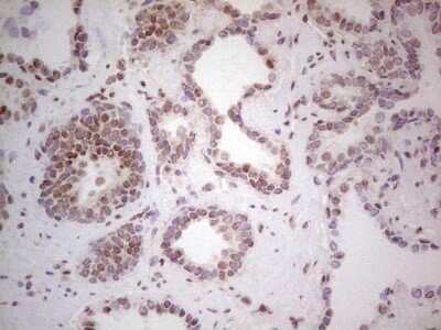 Immunohistochemistry: RAR alpha/NR1B1 Antibody (OTI2C3) - Azide and BSA Free [NBP2-73802] - Analysis of Carcinoma of Human prostate tissue. (Heat-induced epitope retrieval by 1 mM EDTA in 10mM Tris, pH8.5, 120 C for 3min)