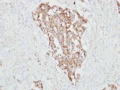 Immunohistochemistry-Paraffin: RARRES1 Antibody [NBP2-20079] - Human lung cancer, using RARRES1  antibody at 1:500 dilution.  Antigen Retrieval: Trilogy™ (EDTA based, pH 8.0) buffer, 15min.