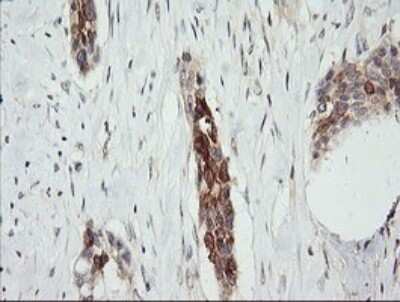 Immunohistochemistry: RARRES1 Antibody (OTI1D2) - Azide and BSA Free [NBP2-73803] - Analysis of Carcinoma of Human bladder tissue. (Heat-induced epitope retrieval by 10mM citric buffer, pH6.0, 120C for 3min)