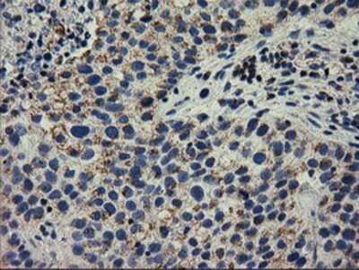 Immunohistochemistry: RASD2 Antibody (OTI1F7) - Azide and BSA Free [NBP2-73808] - Staining of paraffin-embedded Carcinoma of Human bladder tissue using anti-RASD2 mouse monoclonal antibody.