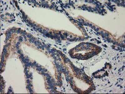 Immunohistochemistry: RASD2 Antibody (OTI1F7) - Azide and BSA Free [NBP2-73808] - Staining of paraffin-embedded Carcinoma of Human prostate tissue using anti-RASD2 mouse monoclonal antibody.