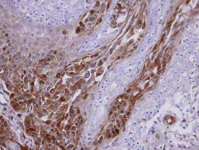 Immunohistochemistry-Paraffin: RASGRP3 Antibody [NBP1-31501] - Paraffin-embedded CA922 xenograft, using antibody at 1:100 dilution.