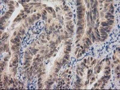 Immunohistochemistry: RASSF1 Antibody (OTI2B11) - Azide and BSA Free [NBP2-73786] - Staining of paraffin-embedded Carcinoma of Human lung tissue using anti-RASSF1 mouse monoclonal antibody.