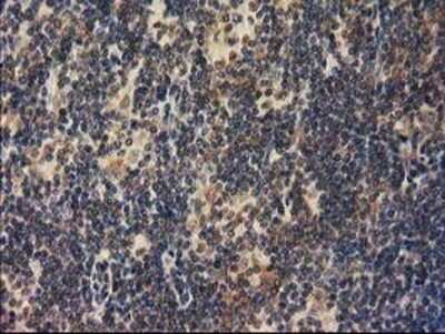 Immunohistochemistry: RASSF1 Antibody (OTI2B11) - Azide and BSA Free [NBP2-73786] - Staining of paraffin-embedded Human lymphoma tissue using anti-RASSF1 mouse monoclonal antibody.