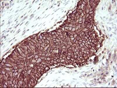 Immunohistochemistry: RASSF8 Antibody (1F5) [NBP2-45530] - Analysis of Carcinoma of Human lung tissue.(Heat-induced epitope retrieval by 10mM citric buffer, pH6.0, 120C for 3min)