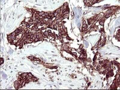 Immunohistochemistry: RASSF8 Antibody (OTI1F5) - Azide and BSA Free [NBP2-73820] - Analysis of Carcinoma of Human bladder tissue. (Heat-induced epitope retrieval by 10mM citric buffer, pH6.0, 120C for 3min)