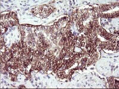 Immunohistochemistry: RASSF8 Antibody (OTI1F5) - Azide and BSA Free [NBP2-73820] - Analysis of Carcinoma of Human prostate tissue. (Heat-induced epitope retrieval by 10mM citric buffer, pH6.0, 120C for 3min)