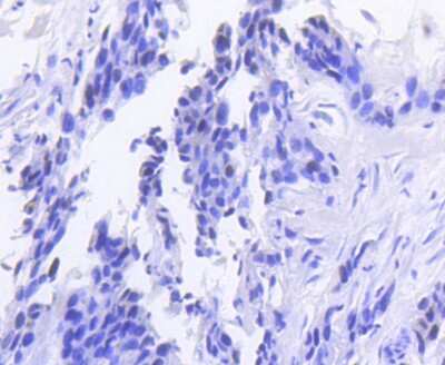 Immunohistochemistry-Paraffin: RB1 Antibody (SY63-03) [NBP2-67453] - Analysis of paraffin-embedded human breast carcinoma tissue using anti-Rb antibody. Counter stained with hematoxylin.