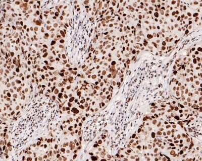Immunohistochemistry-Paraffin: RB1 Antibody (SY63-03) [NBP2-67453] - Analysis of paraffin-embedded human breast carcinoma tissue with Rabbit anti-Rb antibody. The section was pre-treated using heat mediated antigen retrieval with Tris-EDTA buffer (pH 9.0) for 20 minutes. The tissues were blocked in 1% BSA for 20 minutes at room temperature, washed with ddH2O and PBS, and then probed with the primary antibody for 1 hour at room temperature. The detection was performed using an HRP conjugated compact polymer system. DAB was used as the chromogen. Tissues were counterstained with hematoxylin and mounted with DPX.