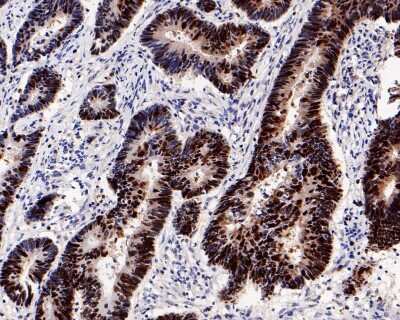 Immunohistochemistry-Paraffin: RB1 Antibody (SY63-03) [NBP2-67453] - Analysis of paraffin-embedded human colon carcinoma tissue with Rabbit anti-RB1 antibody washed with ddH2O and PBS, and then probed with the primary antibody at 1/800 dilution for 1 hour at room temperature. The detection was performed using an HRP conjugated compact polymer system. DAB was used as the chromogen. Tissues were counterstained with hematoxylin and mounted with DPX.