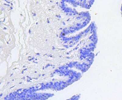 Immunohistochemistry-Paraffin: RB1 [p Ser807] Antibody (SR3-82) [NBP2-67338] - Analysis of paraffin-embedded human breast carcinoma tissue using anti-Phospho-Rb(S807) antibody. Counter stained with hematoxylin.