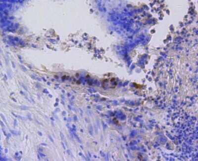 Immunohistochemistry-Paraffin: RB1 [p Ser807] Antibody (SR3-82) [NBP2-67338] - Analysis of paraffin-embedded human colon cancer tissue using anti-Phospho-Rb(S807) antibody. Counter stained with hematoxylin.