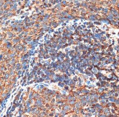 Immunohistochemistry-Paraffin: RB1CC1 Antibody [NBP2-93785] - Human esophageal cancer using FIP200 Rabbit pAb at dilution of 1:100 (40x lens).