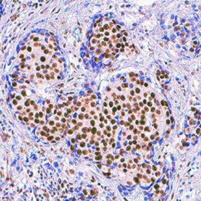 Immunohistochemistry-Paraffin: RBBP 4/7 Antibody (968721) [MAB9457] - Antibody was detected in immersion fixed paraffin-embedded sections of human breast cancer tissue.