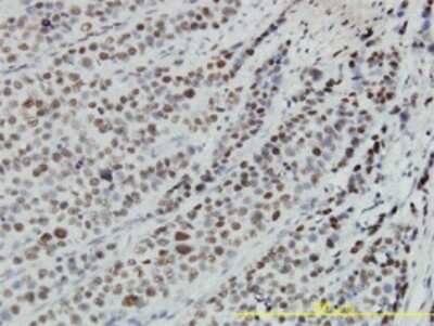 Immunohistochemistry-Paraffin: RBBP4/RbAp48 Antibody (2D7) [H00005928-M01] - Analysis of monoclonal antibody to RBBP4 on formalin-fixed paraffin-embedded human transitional cell carcinoma tissue. Antibody concentration 3 ug/ml.