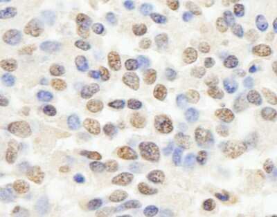 Immunohistochemistry-Paraffin: RBBP4/RbAp48 Antibody [NB100-60399] - Sample: FFPE section of human Ewing sarcoma. Antibody: Affinity purified rabbit anti- RBBP4/RbAp48 used at a dilution of 1:200 (1ug/ml). Detection: DAB