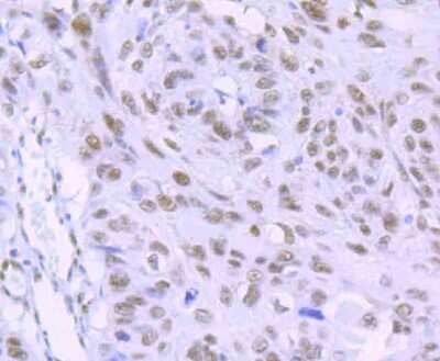 Immunohistochemistry-Paraffin: RBBP4/RbAp48 Antibody (JU37-47) [NBP2-75642] - Analysis of paraffin-embedded human lung cancer tissue using anti-RbAP48 antibody. Counter stained with hematoxylin.