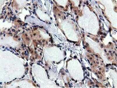 Immunohistochemistry: RBBP9 Antibody (OTI4G3) - Azide and BSA Free [NBP2-73828] - Staining of paraffin-embedded Carcinoma of Human thyroid tissue using anti-RBBP9 mouse monoclonal antibody.