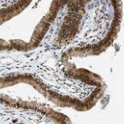 Immunohistochemistry: RBM15 Antibody [21390002] - A majority of normal and malignant tissues showed moderate to strong nuclear and moderate cytoplasmic staining. In normal tissues, strongest positivity was found in gastro-intestinal glandular cells and in neuronal cells of the CNS. Prostate, bile duct cells and ovarian stromal cells were negative. Malignant tissues stained similarly, with strongest immunoreactivity found in colo-rectal cancers and malignant gliomas. Other tumors generally displayed moderate nuclear and cytoplasmic staining. Most prostate cancers were negative.  Image and statement courtesy of the Human Protein Atlas (HPA).