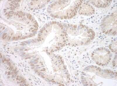 Immunohistochemistry: RBM17 Antibody [NBP1-80576] - Sample: FFPE section of human colon carcinoma. Antibody: Affinity purified rabbit anti-SPF45 used at a dilution of 1:250 Detection: DAB staining using Immunohistochemistry Accessory Kit .