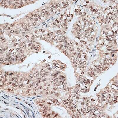 Immunohistochemistry-Paraffin: RBM17 Antibody [NBP2-94654] - Paraffin-embedded human endometrium cancer using RBM17 .