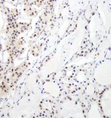 <b>Independent Antibodies Validation and Biological Strategies Validation.</b>Immunohistochemistry: RBM26 Antibody [NB100-60408] - Sample: FFPE section of human thyroid carcinoma. Antibody: Affinity purified rabbit anti- RBM26 used at a dilution of 1:200 (1ug/ml). Detection: DAB