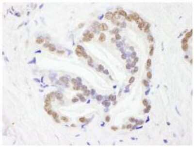 Immunohistochemistry-Paraffin: RBM26 Antibody [NB100-60408] - FFPE section of human prostate carcinoma.  Affinity purified rabbit anti-RBM26 used at a dilution of 1:250.