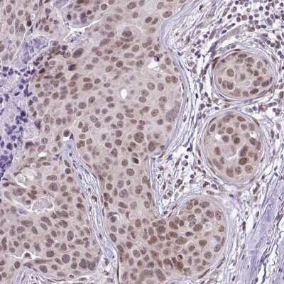 Immunohistochemistry-Paraffin: RBM3 Antibody (CL0296) [NBP2-52906] - Staining of human breast cancer shows moderate nuclear positivity in tumor cells.