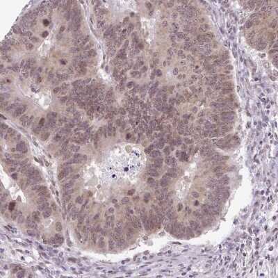 Immunohistochemistry-Paraffin: RBM3 Antibody (CL0296) [NBP2-52906] - Staining of human colorectal cancer shows weak to moderate nuclear positivity in a subset of tumor cells.