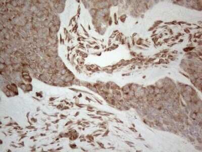 Immunohistochemistry: RBMS1 Antibody (OTI2H1) - Azide and BSA Free [NBP2-73834] - Analysis of Adenocarcinoma of Human endometrium tissue. (Heat-induced epitope retrieval by 1mM EDTA in 10mM Tris buffer (pH8.5) at 120 for 3 min)