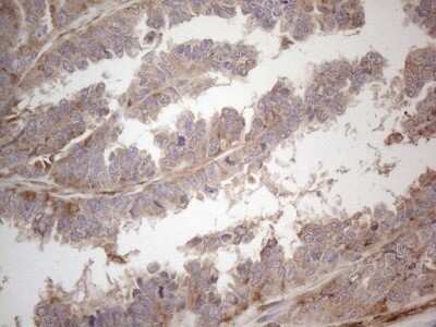 Immunohistochemistry: RBMS1 Antibody (OTI2H1) - Azide and BSA Free [NBP2-73834] - Analysis of Adenocarcinoma of Human ovary tissue. (Heat-induced epitope retrieval by 1mM EDTA in 10mM Tris buffer (pH8.5) at 120C for 3 min)