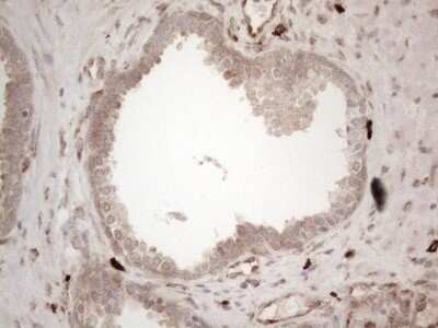 Immunohistochemistry: RBMS1 Antibody (OTI2H1) - Azide and BSA Free [NBP2-73834] - Analysis of Carcinoma of Human prostate tissue . (Heat-induced epitope retrieval by 1mM EDTA in 10mM Tris buffer (pH8.5) at 120C for 3 min)