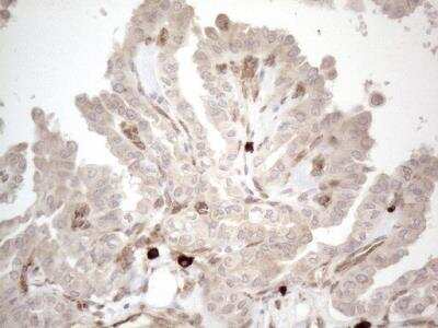 Immunohistochemistry: RBMS1 Antibody (OTI2H1) [NBP2-45533] - RBMS1 Antibody (2H1) [NBP2-45533] - Analysis of Carcinoma of Human thyroid tissue. (Heat-induced epitope retrieval by 1mM EDTA in 10mM Tris buffer (pH8.5) at 120C for 3 min)