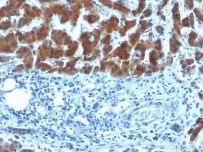 Immunohistochemistry-Paraffin: RBP4/Retinol-Binding Protein 4 Antibody (SPM442) - IHC-Prediluted [NBP2-45016] - Formalin-fixed, paraffin-embedded human Hepatocellular Carcinoma stained with RBP1 (SPM442).