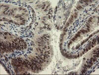 Immunohistochemistry: RBPMS Antibody (2G10) [NBP2-45551] - Analysis of Adenocarcinoma of Human endometrium tissue.