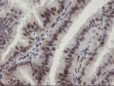 Immunohistochemistry-Paraffin: RBPMS Antibody (3B7) [NBP2-03905] - Staining of paraffin-embedded Adenocarcinoma of Human endometrium tissue using anti-RBPMS mouse monoclonal antibody.