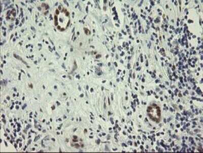 Immunohistochemistry: RBPMS Antibody (OTI2G10) - Azide and BSA Free [NBP2-73835] - Analysis of Carcinoma of Human kidney tissue.