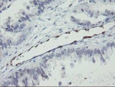 Immunohistochemistry: RBPMS Antibody (OTI3B7) - Azide and BSA Free [NBP2-73836] - Staining of paraffin-embedded Adenocarcinoma of Human ovary tissue using anti-RBPMS mouse monoclonal antibody.