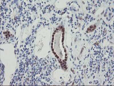 Immunohistochemistry: RBPMS Antibody (OTI3B7) - Azide and BSA Free [NBP2-73836] - Staining of paraffin-embedded Carcinoma of Human kidney tissue using anti-RBPMS mouse monoclonal antibody.