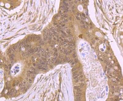 Immunohistochemistry-Paraffin: RBX1 Antibody [NBP2-75643] - Analysis of paraffin-embedded human colon cancer tissue using anti-RBX1 antibody. Counter stained with hematoxylin.