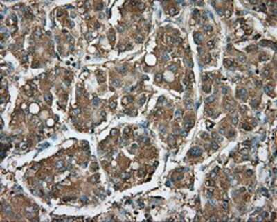 Immunohistochemistry-Paraffin: RDH11 Antibody (1B4) [NBP2-02431] - Staining of paraffin-embedded Carcinoma of liver tissue using anti-RDH11 mouse monoclonal antibody.