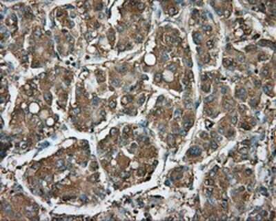 Immunohistochemistry: RDH11 Antibody (OTI1B4) - Azide and BSA Free [NBP2-73843] - Staining of paraffin-embedded Carcinoma of liver tissue using anti-RDH11 mouse monoclonal antibody.