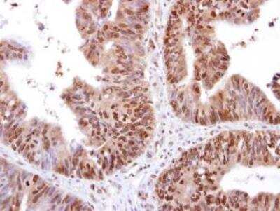 Immunohistochemistry-Paraffin: RED Antibody [NBP1-30927] - RED antibody [N1], N-term detects RED protein at cytosol and nucleus on human colon carcinoma by immunohistochemical analysis. Sample: RED antibody [N1], N-term (NBP1-30927).Antigen Retrieval: Trilogy(TM) (EDTA based, pH 8.0) buffer, 15min